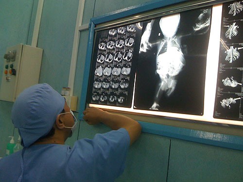 Qua thăm khám và hình ảnh học cho thấy bé Luyền có khối u phát triển từ vùng ngực bụng bên trái